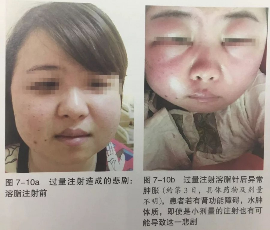 溶脂针真的可以消除脂肪吗 副作用是什么 采美365网